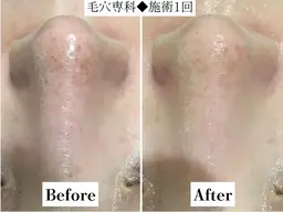 人気No.3内側から潤う《高濃度VC導入付き》毛穴洗浄ハイドロfacial🫧