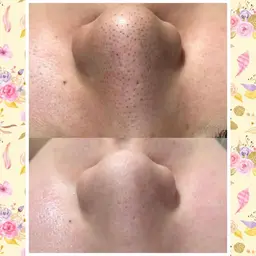 🍓鼻を撲滅❗毛穴クリーンケア モニター価格!