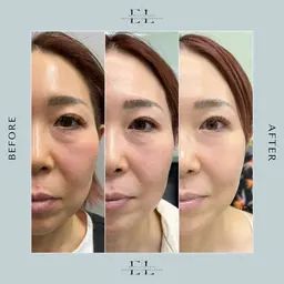 ExoLift エクソリフト【自己再生能力を最大限に引き出す肌改善プログラム】