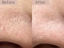 【ハーブピーリング2カ所お試し】剥離無orブレンドハーブピーリング¥18000→