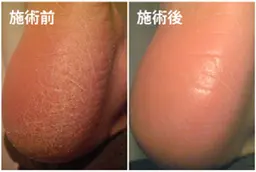 かかと角質取り
