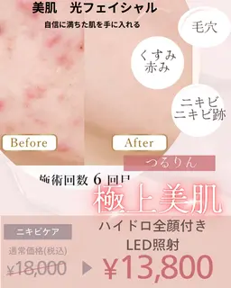 🎊新メニュー🎊🌟美肌光フェイシャル🌟【ニキビケア】【毛穴ケア】ハイドロスプラッシュ×LED照射付き★
