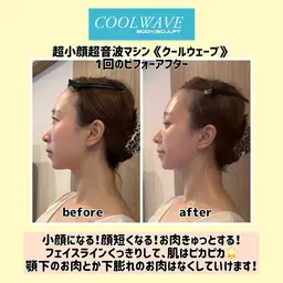 超小顔超音波マシン《クールウェーブ》