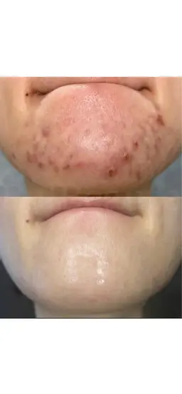 【女性専用/皮むけなし/ソフト】ニードルハーブピーリング🩵ハーブ初めての方や敏感肌の方にも✨首肩マッサージ付き🌟