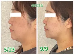 【フェイスライン集中ケア】首との境目のもたつきにお悩みの方へ