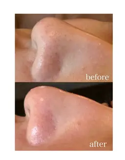 【*10名様限定*平日モニター募集】アクアピール+毛穴洗浄×高保湿ポレーション導入　全顔　2回　¥9800