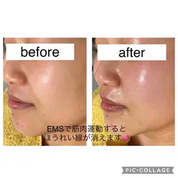 針を刺さないボトックス？！深部へ医療用電気でピュアコラーゲン&ヒアルロン酸をチューブ丸々1本導入✨