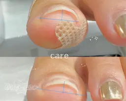 【フット】両親指のみ巻き爪ケア