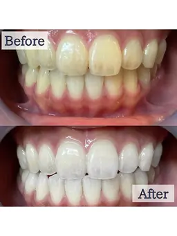 【👑人気No.1👑】 5分照射×2回🦷通常の約2倍の照射パワー🔥最新高速ハイパワーセルフホワイトニング🎶