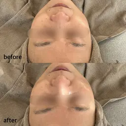 ハーバルフルーツピーリング ✩.*˚ ハリ、ツヤ激変!肌質改善