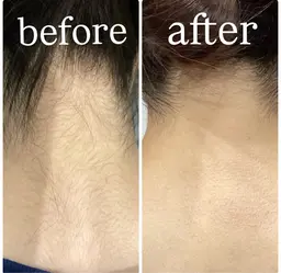 後ろ姿美人✨うなじ脱毛お試し　2,200円