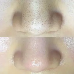 〈Aプラン〉毛穴ゼロシンプルコース