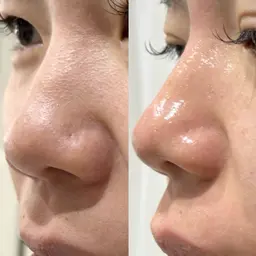 【初回】フェイシャルエステ＋松ヤニパック✨毛穴侍全顔付き（ミニモ限定）