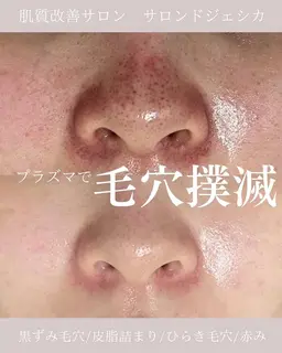 【ミニモ限定❗️SNSでも話題の毛穴革命✨】プラズマフェイシャル毛穴洗浄or美肌フォト肌管理コース