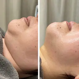 【1周年感謝祭　スペシャル企画】小顔施術🍋二重顎・フェイスラインを引き締めたい方に✨