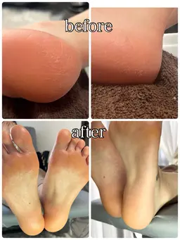 冬のカサカサ撃退！赤ちゃん足角質ケア🦶✨