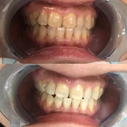 💎初回限定💎🦷ホワイトニング未経験者🦷やホワイトニングマニアの方【🌈30分照射¥9900➡️¥2980円🌈】