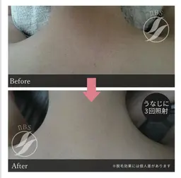 Sパーツ…（脇・襟足・手の甲・指・足の甲・指・乳輪・へそ周りから1箇所）１７歳未満は30%OFF（要同意書）コース有