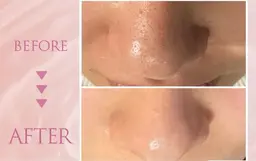 【初めての方限定】韓国式毛穴洗浄ハイドロヴィーナス✴︎美容液仕上げ