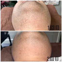 🔷メンズ　顔ヒゲ脱毛🔷　初回体験