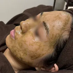 《ミニモ学割》低刺激で痛くない!ダウンタイムなし!剥離なしハーブピーリング🌿当日メイクOK👌メンズも歓迎✨