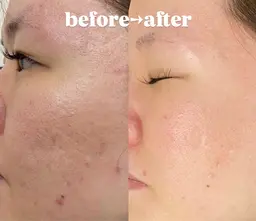 リピーター多数🌈ツヤ肌になれる【💎水光ツヤ肌フェイシャル💎】