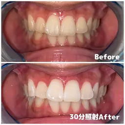 【 歯本来の自然な白さを目指していきます 】🔹高濃度ナチュラルホワイトニング〈 30分照射 〉🔹