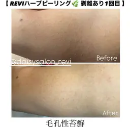 背中上・背中下・肘下・肘上・膝下・膝上・お尻・お腹・デコルテ・バスト 【 お好きな箇所 】REVIハーブピーリング🌿