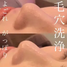 《平日限定》黒ずみ毛穴撃退💥【ハイドロ毛穴洗浄】ブラックヘッド/角栓/ニキビ/ニキビ跡