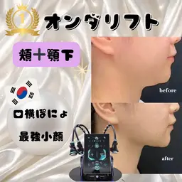 オンダリフト30分|頬~顎下80kj~140kj
