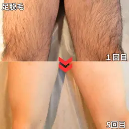 【ミニモ初回限定50%オフ】膝下から足首脱毛