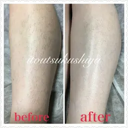 ひざ下の糸脱毛体験🧵