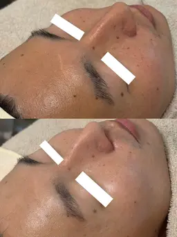 【韓国白玉美肌毛穴レスコース】