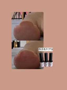 フット巻き爪ケア、巻き爪で痛みがある、伸びると痛みがある方