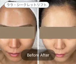 【10名限定】《女性顔出し可能な方のみ》ビフォーアフター写真提供 ララシークレットを用いたララシークレットリフト