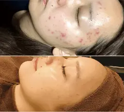 【毛穴・ニキビ🔥】剥離なしハーブピーリング＋毛穴洗浄or高濃度美容液導入エレクトロポレーション¥9,000