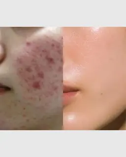 【初回限定】大人ニキビケア|美容鍼×フェイシャルケア