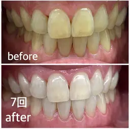 『お試し!結果に自信!歯科衛生士×医療提携!白くなる歯のセルフホワイトニング』🦷✨