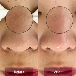 毛穴エクストラクションモニター大募集(1月限定)