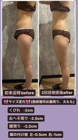 キャビテーション×リンパマッサージ