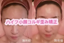 【小顔うるツヤ美肌】ハーブピーリング×超音波×小顔矯正¥24980→13480