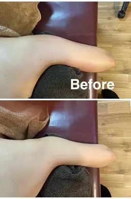 【二の腕・痩身】ミニモ限定／話題の痩身マシンで二の腕下のたるみ肉へアプローチ！