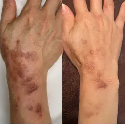 プロセルボディ（妊娠線・傷跡）