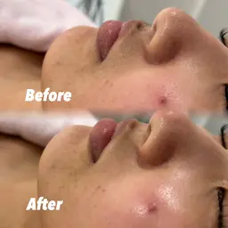 【動画撮影OKな方🎞⟡.·】⚠️土曜日19:00​〜​限定⚠️ 顔シェービング+パック