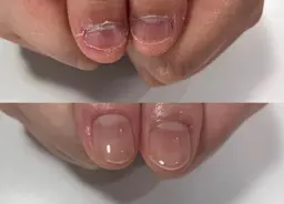 自爪で深爪矯正【噛み、むしりで爪が短くなった方】