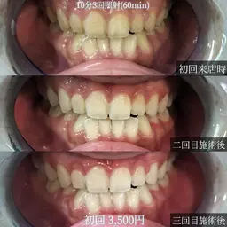 歯のプレミアムホワイトニング🖤初回50分→60分照射¥5000🖤+オプション無料グレードアップ