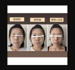 EMS搭載!3in1美顔器使用のトリートメント