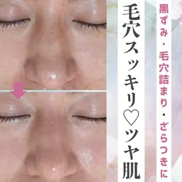 〈毛穴の黒ずみに🌟〉ハイドラフェイシャル