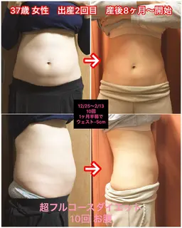 【早割】ラジオ波&キャビ　お得セット〔お腹〕