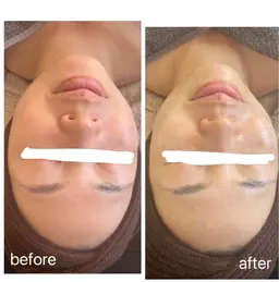 陶肌トリートメント（剥離なしハーブピーリング）再生因子コース💋リップトリートメント付
